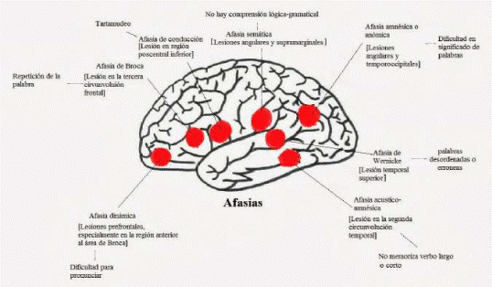 Zonas del cerebro afectadas seg&uacute;n el tipo de afasia Afasia de Broca Repetici&oacute;n de la [Lesi&oacute;n en la tercera palabra cirvunvolui&oacute;n